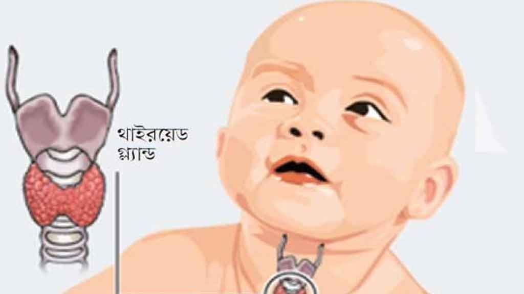 থাইরয়েড হানা দিতে পারে শিশুকে, লক্ষণ দেখে সাবধান হোন